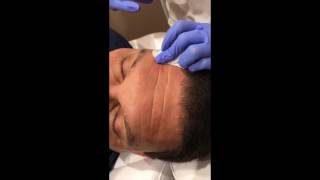 Deep Forehead Lines Removed by Belotero Filler in NYC [upl. by Alaster]