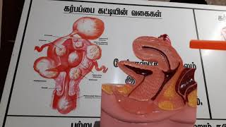 Fibroid uterus in tamiluterine fibroids treatment in tamilinfertility causes in tamilgrn hospital [upl. by Roslyn645]