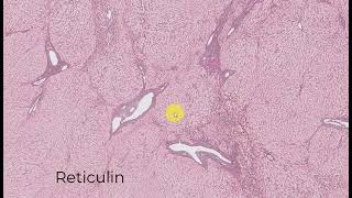 A Dummies Guide to Pathologic Staging of Prostate Cancer Radical Prostatectomy Specimen [upl. by Feigin]