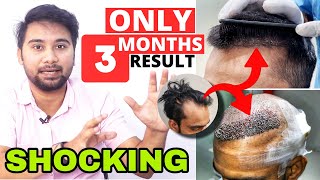 This 3 Months Hair Transplant Result Will Shock You  Natural Looking Hairline By Hair Transplant [upl. by Chloe364]