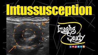 Intussusception  Ultrasound  Case 154 [upl. by Nayd11]