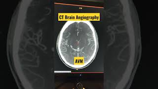 CT Brain Angiography Diagnosing AVM shorts trending viral radiology [upl. by Nitas]