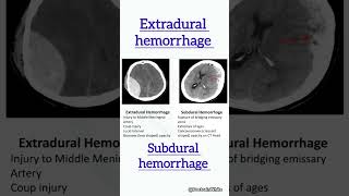 Extradural vs subdural hemorrhage  viralshorts hemorrhage [upl. by Aikemehs]