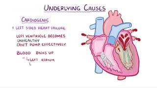 Pulmonary Edema causes symptoms diagnosis treatment pathology [upl. by Eugen]