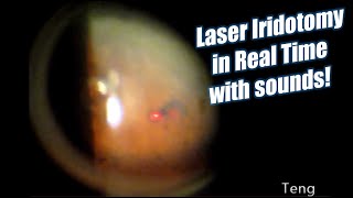 Laser Iridotomy in Real Time with Laser Sounds Chris Teng MD [upl. by Semyaj]