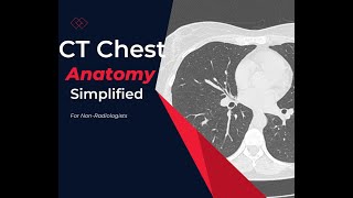 CT chest Anatomy Made simple For Medical students residents and clinicians [upl. by Erodroeht]