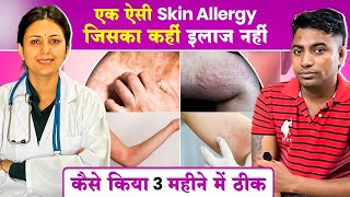 देखिये कैसे Skin Allergy URTICARIA का इलाज हुआ 3 महीनों में  URTICARIA Cure  Dr Upasana Vohra [upl. by Gwenny836]