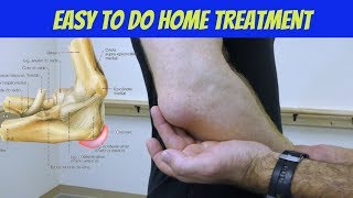 Elbow Bursitis Treatment at Home  How to Treat Olecranon Bursitis [upl. by Ecnedac]