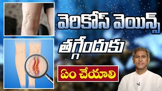 VaricoseVeins Treatment  Health Tips in Telugu  ManthenaSatyanarayanaRajuVideos [upl. by Asined]