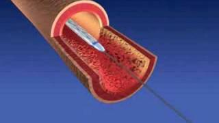 Balloon Angioplasty and Stent Implantaion [upl. by Alleunam648]