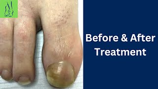 Toenail Fungus Treatment  Before amp After Pictures [upl. by Acimad]