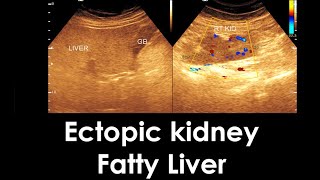 Practical case  Ectopic kidney  Fatty infiltration of the Liver  Ovarian cyst [upl. by Adnahc]