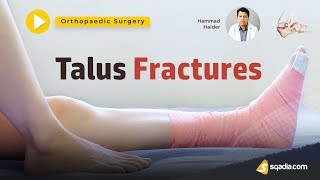 Talus Fractures  Orthopaedic Surgery Lectures  Medical Student  VLearning [upl. by Vonnie]