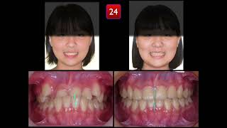 Nonextraction Treatment of Pseudo Class III malocclusion｜【Chris Chang Ortho】CC706 [upl. by Yelsew]