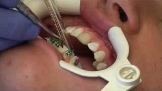 Just Orthodontics  How we put Damon Q braces on your teeth [upl. by Iives646]