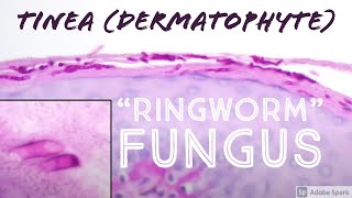 quotRingwormquot under microscope Fungus Skin Infection TineaDermatophyte 5Minute Pathology Pearls [upl. by Nnyliak]