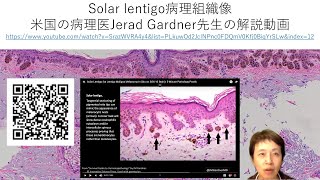 solar lentigo病理組織像の解説 [upl. by Eclud690]