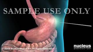 What is Percutaneous Endoscopic Gastrostomy PEG [upl. by Leonore]