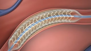 Absorbable Stent [upl. by Anatnom]