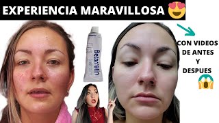 RETINOL ANTES Y DESPUES😱 TRETINOINA MI EXPERIENCIA DESPUES DE 6 MESES betarretin acido retinoico [upl. by Anola410]