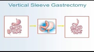 Robotic Sleeve Gastrectomy Video  Brigham and Womens Hospital [upl. by Elpmid]