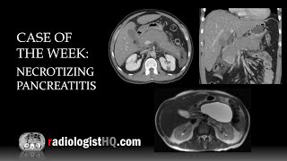 Case of the Week Necrotizing Pancreatitis CT amp MRI [upl. by Hirz572]