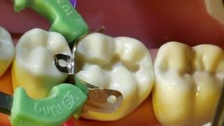 Composite Fill Walkthrough tutorial for 19 MO Approximal Box and Occlusal Fill [upl. by Nuawed212]