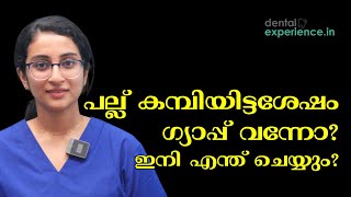 കമ്പിയിട്ടശേഷവും പല്ലുകൾക്ക് ഗ്യാപ്പ് വന്നോ Teeth gap  Gap between teeth after wearing braces [upl. by Anaic]