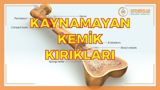 KAYNAMAYAN KEMİK KIRIKLARININ TEDAVİSİ [upl. by Farmer]