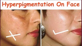 6 Home Remedy for Pigmentation Hyperpigmentation Brown Spots Discoloration Remove [upl. by Gaven]