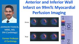 Anterior and inferior wall infarct on 99mTc myocardial perfusion imaging [upl. by Senga231]