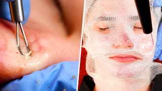 Acne Facial  Blackhead Extractions [upl. by Gladdy122]