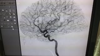 Cerebral Angiography [upl. by Eintroc]