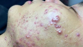 ACNE TREATMENT VU QUYNH MI Blackheads On Boy Face 2024 [upl. by Yur]