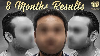 Amazing Hair Transplant Journey  8Month Hair Transplant Results  MedLinks [upl. by Alhsa]