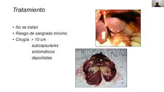 tumores hepáticos benignos [upl. by Palermo]