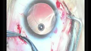 scleral fixation of foldable IOL in the sulcus above the decentered bag [upl. by Arrio]