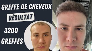 Résultat de la greffe de cheveux 3200 greffons l Avant et après l Greffe de cheveux en Turqui [upl. by Ycniuqal381]