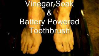 Home Remedy for Fungus Home Remedy for Fungus Toenail [upl. by Kenney]