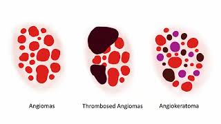 Angiomas and variants  Dr C Navarrete Dechent [upl. by Elletsirk]