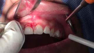 Periotip Nivelacion de margenes gingivales en alargamiento de corona [upl. by Nochur142]