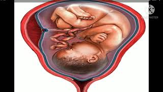 Polyhydramnios Hydramnios excess amniotic fluid [upl. by Netsrak]