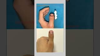 Stub thumb lengthening brachydactylyTypeD MegenFox ToethumbBrachydactyly Doctor Thumb [upl. by Harod]