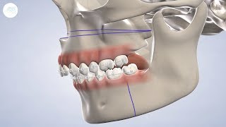 TMJ Treatment in Modesto CA  Greater Modesto Dental Implant amp Oral Surgery Center [upl. by Herrington]