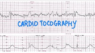 Question on cardiotocography  important topic for norcet  aiimsnorcet norcetpreparation ctg [upl. by Eitsirhc]