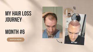 Month 6 Hair transplant RESULTS HLC Clinic Before amp After at the end [upl. by Jenni]