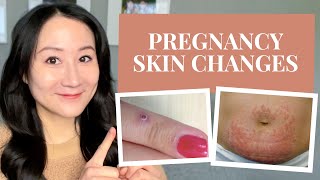 Pregnancy Skin Changes  Stretch Marks Melasma Rashes  More  DR JENNY LIU [upl. by Liemaj138]