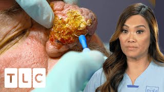 Dr Lee Transforms Patients Hugely Overgrown Nose I Dr Pimple Popper Pop Ups [upl. by Kristopher]