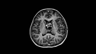 11 year old girl with mixed tumor teratoma and germinoma based on histopathology diagnosis [upl. by Ridgley]