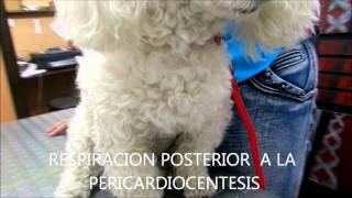 PERICARDIOCENTESIS  CITOLOGIA CON CELULAS NEOPLASICAS [upl. by Norbert]